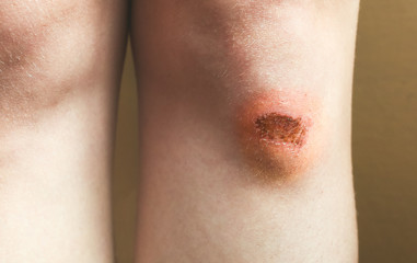 Fototapeta premium Abrasion on the woman's knee. Injured leg with a red wound. Medical treatment for first aid.