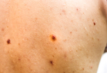 Fototapeta premium Many birthmarks on the girl's back. Medical health photo. Woman's oily skin with problems acne.