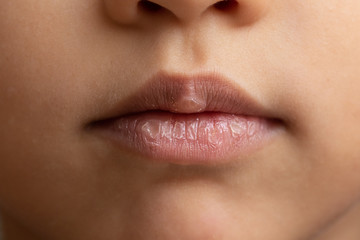 Chapped lips of a little girl, the cold winter climate has caused dry lips with cracks