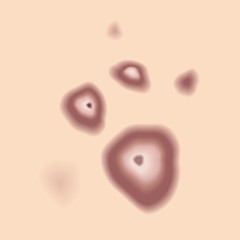 ニキビ　吹き出物　種類