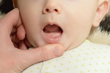 The tongue of the newborn was examined, and a tongue was discovered when the frenum is short and limits the mobility of the tongue © Viktory