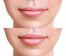 Sensual female lips before anf after augmentation procedure.