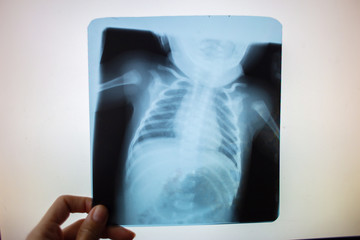 X-ray picture of the abdominal organs of a small child in the lumen on a white screen. Medical devices
