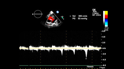 Image of the heart during transesophageal ultrasound with Doppler mode.