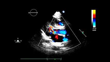 Image of the heart during transesophageal ultrasound with Doppler mode.