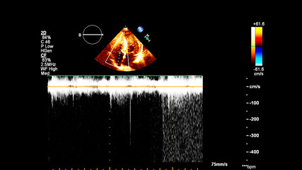 Image of the heart in gray-scale mode during transesophageal ultrasound.
