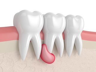 3d render of teeth in gums with cyst