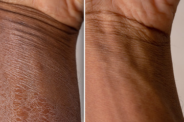 Fototapeta dry skin before and after treatment: therapy concept for dry and dehydrated skin obraz