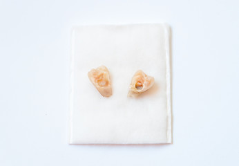 Old broken milk tooth from kid mouth after visiting dentist at clinic, decayed teeth broke in half