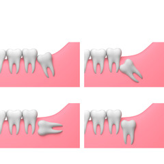 Types of wisdom tooth impactions, white background, collage, 3D-render illustration