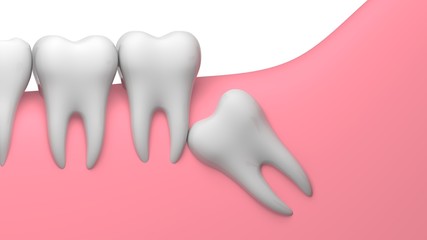 Wisdom tooth angular impaction illustration, 3D-rendering, white background