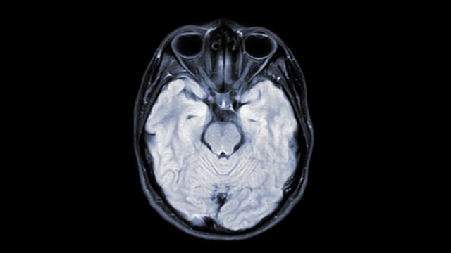 MRI of the brain  axial t2 flair  for detect brain stroke disease.