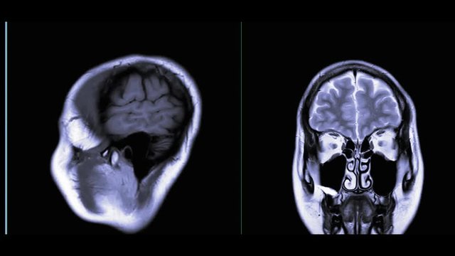 Comparison MRI of the brain  sagittal and Coronal plane  for detect a variety of conditions of the brain such as cysts, tumors, bleeding, swelling, developmental and structural abnormalities.