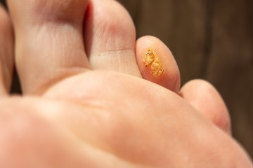 Wart (verrucae plantares) on a toe on a foot as a typical skin disease