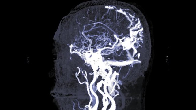 CTA Brain or computed tomography angiography of the brain 3D  MIP  image  showing Brain AVM or arteriovenous malformation turn around on the screen.