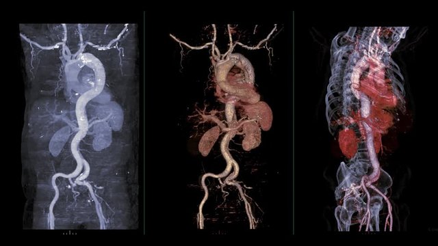 Compare CTA Whole aorta  Mip image ,3D rendering image and 3D and bone image  turn around on the screen showing Aortic dissection.