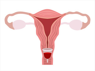 Menstrual cup - feminine hygiene product, device for collecting blood during menstruation and period is used inside the vagina of woman female