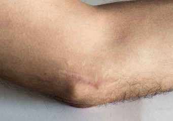 elbow with scar