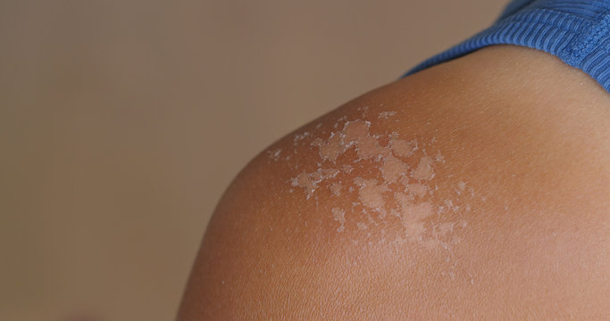 Sunburned skin, peeling skin from a sunburn