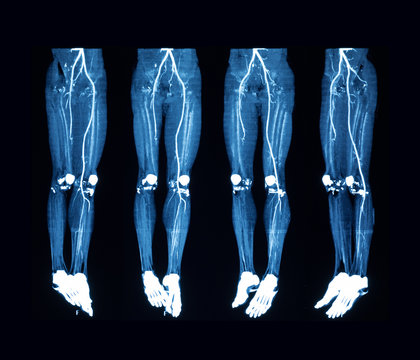 Computed tomography angiography (CTA ) of lower extremity