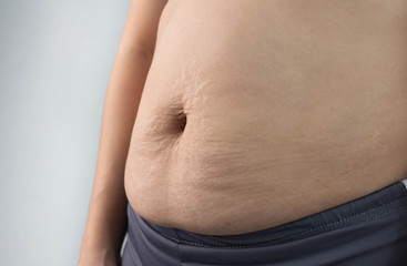 Close up of Woman showing belly skin with stretch marks and loose skin after giving birth. Health...