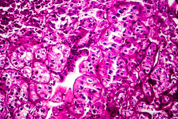 Kidney cancer, light micrograph