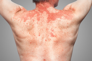 Skin allergy to the human body, Peanut Allergy