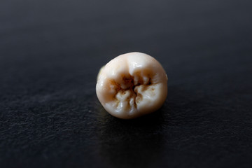 Torn out human tooth. Caries close-up. Tooth loss. Torn tooth on a black background. Bad unattractive tooth. 
