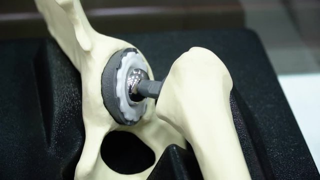 Example of a human femoral prosthesis with metal prostheses