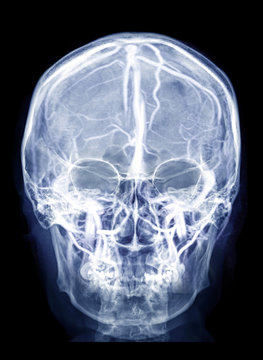  Skull x-ray image of Human skull AP view  mix with MRV Brain image showing Venous sinuses of brain in skull.