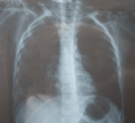 View of a child x-ray film, taken to examine the lungs. Pneumonia.