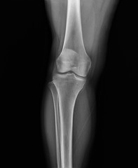 normal radiography of the knee joint in the frontal projection medical diagnostics, Traumatology and orthopedics