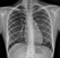 normal radiography of chest organs in direct projection,  pulmonology