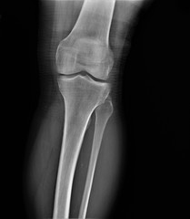 normal radiography of the knee joint in the frontal projection medical diagnostics, Traumatology and orthopedics
