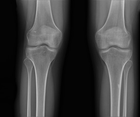 normal radiography of the knee joint in the frontal projection medical diagnostics, Traumatology and orthopedics