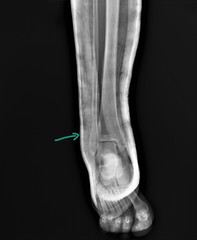 Obraz premium radiograph of the ankle joint with a fracture of the outer ankle without displacement, traumatology, medical diagnostics