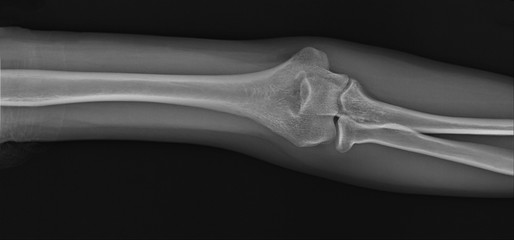 x-ray of the normal elbow joint. traumatology and orthopedics, medical diagnostics, rheumatology