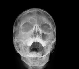 radiography of the paranasal sinuses of the skull, medical diagnosis