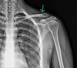 radiography of the shoulder joint and ribs in direct projection with a fracture of the collarbone,...