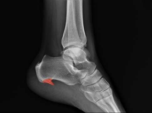 radiograph of the ankle joint in the lateral projection, heel spur.Osteoarthritis, Osteoporosis