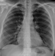 normal radiography of chest organs in direct projection,  pulmonology