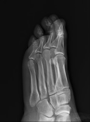 normal radiography of the foot, medical diagnostics, traumatology and orthopedics, rheumatology