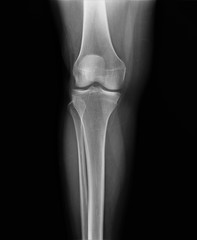 normal radiography of the knee joint in the frontal projection medical diagnostics, Traumatology and orthopedics