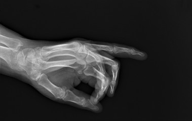radiography of bones and fingers with arthrosis, orthopedics, medical diagnostics, Rheumatology