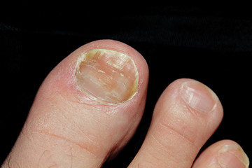 Start Fungal Infection Toe