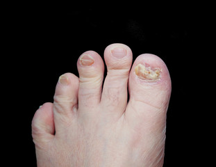 Foot with toenail fungus Isolated