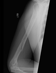 X-ray of a broken humerus bone which was fractured in a hang gliding accident. Bone starting to heal, X-ray taken 4 months after break.