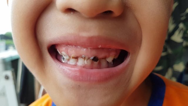 Close up Little child Show Broken teeth boy with a Teeth broken and caries