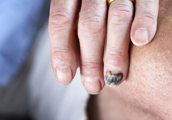 Subungual hematoma blue nail or bruised on ring finger closeup man background