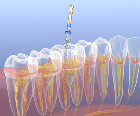 Endodontic root canal treatment process. Medically accurate tooth 3D illustration.